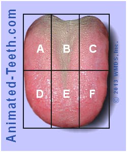 Illustration showing the Winkel Tongue Coating Index grid superimposed on a picture of a tongue.