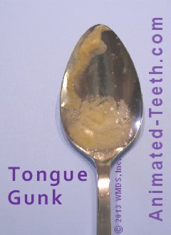 Image of spoon full of bacterial debris scraped off a person's tongue.