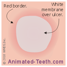 Link to canker sore mouth ulceration diagram.