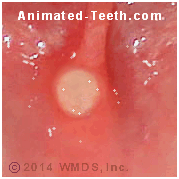Link to pictures of aphthous ulcers.