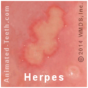 Link to pictures of herpes and canker sores.