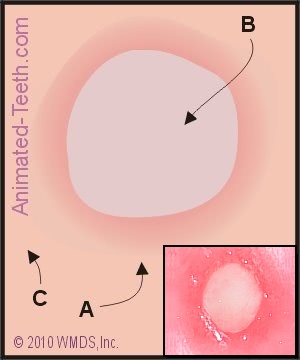 Diagram showing the physical characteristics of an aphthous ulcer.