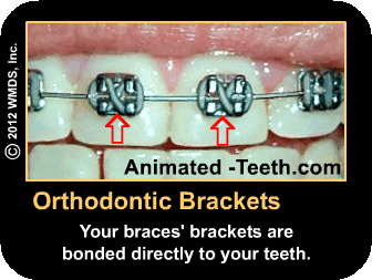 Slideshow pointing out the components of conventional dental braces.