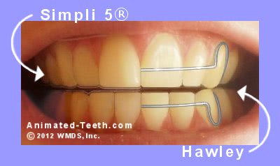 A picture showing orthodontic case treatment using a Hawley appliance or Simpli 5®.