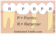 Illustration showing a 5-unit dental bridge composed of 3 retainers and 2 pontics.