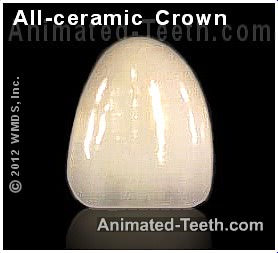 Picture of an all-ceramic dental crown for a front tooth.