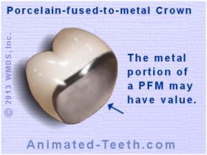 Picture of a porcelain-fused-to-metal dental crown that has scrap value.