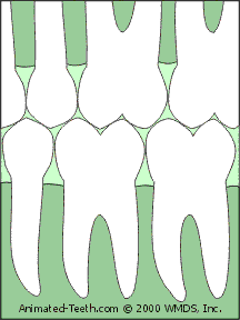 Animation showing how losing a tooth allows the neighboring teeth to shift.