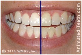 Picture of a case in a split-arch tooth whitening study.