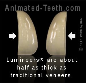 Picture comparison of the thickness of Lumineers® vs. conventional porcelain veneers.