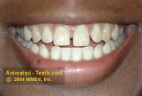 Picture of makeover case before porcelain veneers.