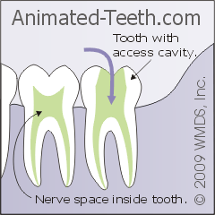 Diagram showing where an access cavity is placed in a molar.