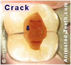 Link to endodontic failure due to tooth cracks section.