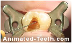 A picture showing conventional (orthograde) root canal retreatment.