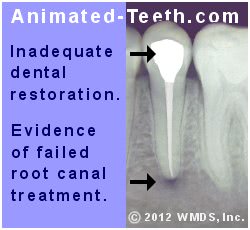 Picture of an x-ray showing failed root canal treatment due to coronal leakge.