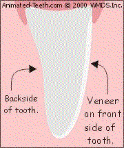 Teeth with veneers can often be successfully whitened.