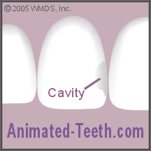 Animation showing making the cavity preparation for a dental composite restoration.