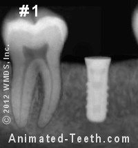 Slideshow of X-rays showing the component parts of an dental implant.