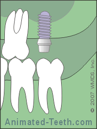 Animation showing that a dental implant cannot be placed in the area of the maxillary sinus.