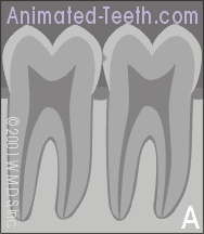 Animated illustration showing how the progression of tooth decay looks on a dental x-ray.
