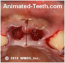 Picture of tooth extraction sockets with a suture placed.