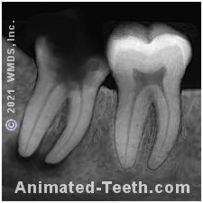 X-ray of a molar slated for extraction.