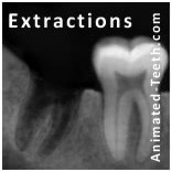A post-extraction x-ray of the tooth's socket.