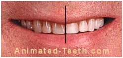 Picture showing before and after results of teeth whitening.
