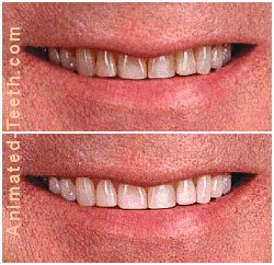 Before and after picture of teeth whitening results.