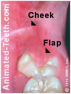 Picture showing a wisdom tooth covered by a flap of gum tissue.