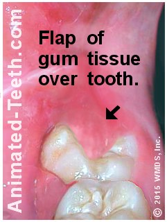 A wisdom tooth operculum (extra flap of skin).