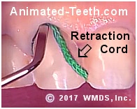Picture of placing retraction cord before impression taking.