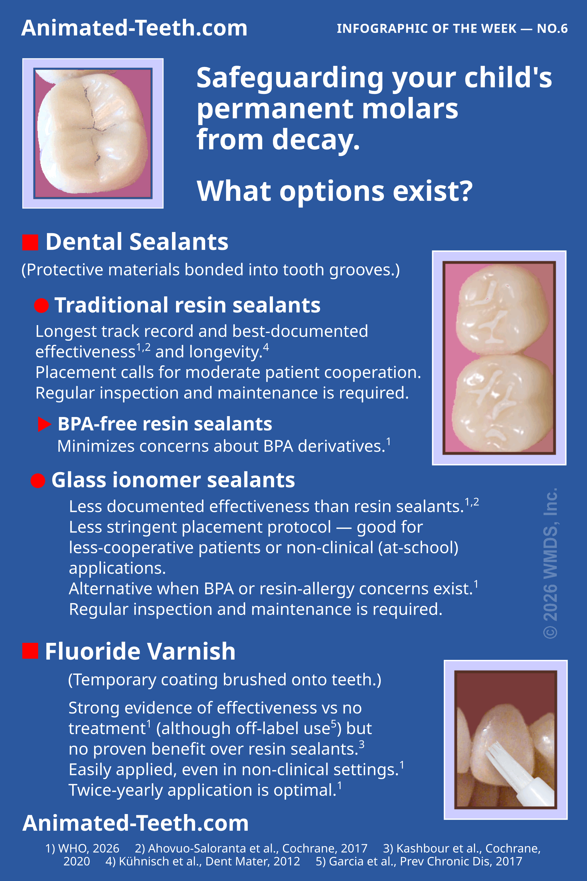 Infographic: Options for protecting a child's permanent molars from decay, covering resin dental sealants, glass ionomer sealants, and fluoride varnish.