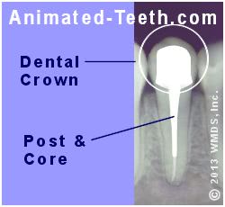 Link to What is a Post & Core section.