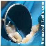 Picture of rubber dam in place before placing dental composite.