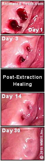Pictures showing the stages of tooth extraction site healing over time (1 to 4 weeks).