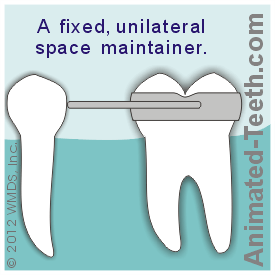 Illustration of a fixed, unilateral space maintainer cemented in place.