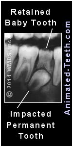 X-ray showing retained baby tooth due to the impaction of its replacement tooth.