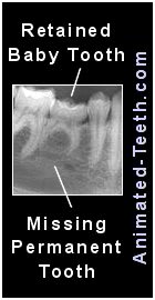 X-ray showing a retained baby tooth due to no permanent tooth replacement.
