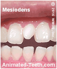 Link to What is a mesiodens section.