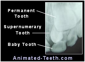 X-ray of maxillary supernumerary tooth that interferes with adjacent permanent tooth eruption.