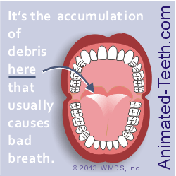 Graphic stating that halitosis is usually caused by plaque accumulation on the back part of the tongue.