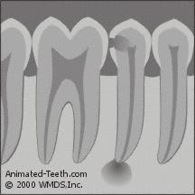 Illustration of an X-ray of a decayed tooth with an abscess.