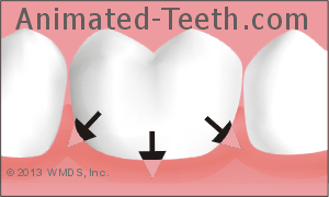 Illustration showing where bacteria that can cause halitosis accumulate underneath the gum line.