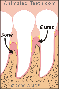 Animation showing periodontal pockets that harbor bacteria that cause halitosis.