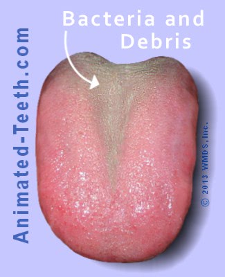 Picture showing bacterial accumulation on the back part of the tongue.