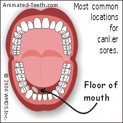 Animated graphic showing the mouth locations where aphthous ulcers typically form.