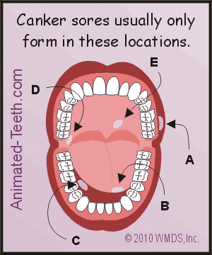 Slideshow showing where aphthous ulcers and oral herpes usually form.