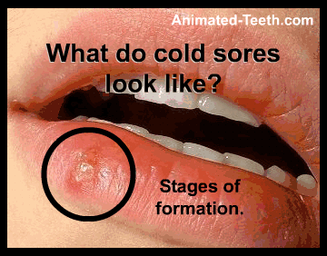 Slideshow showing pictures of the stages of cold sore formation.