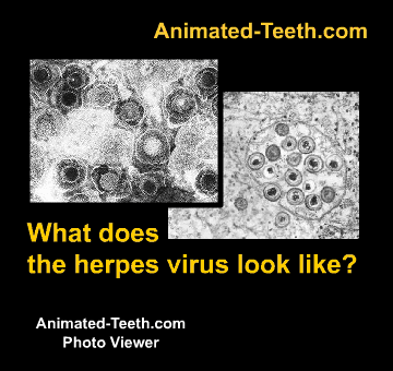 Sideshow of pictures of herpes simplex virions.